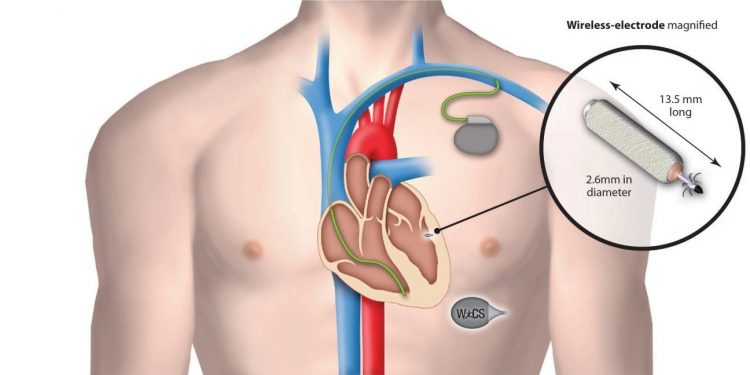 زراعة أجهزة تنظيم ضربات القلب وانتشار المخدرات.. دراسة تكشف العلاقة بينهم 1