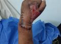 عودة "يد" مبتورة من ذراع شاب في حادث سيارة بأسيوط 5