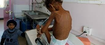 وزير الصحة اليمني : مالا يقل عن الف طفل يموتون يوميا نتيجة تضرر قطاع الصحة 8