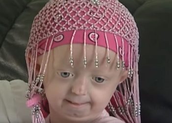 شيخوخة مبكرة لدى طفلة أوكرانية تؤدي لوفاتها 6