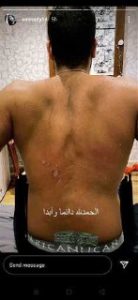 إصابة اليوتيوبر عمرو راضي بالحروق في الظهر (صور) 4