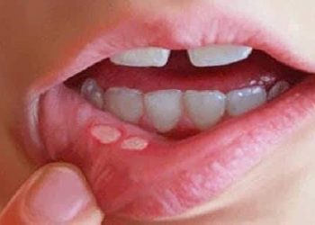 "الكتل و التقرحات والنزيف".. 10 أعراض مبكرة تكشف عن الإصابة بسرطان الفم 1