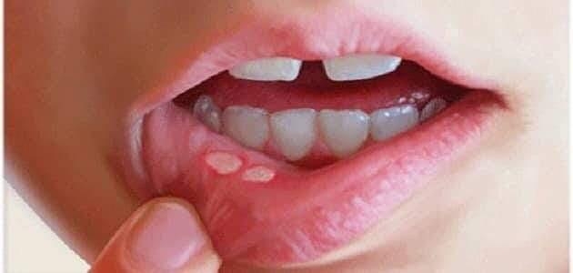 "الكتل و التقرحات والنزيف".. 10 أعراض مبكرة تكشف عن الإصابة بسرطان الفم 1