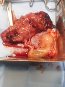 إزالة جنين «حمل» خارج الرحم بمستشفى بيلا بكفر الشيخ(صور) 2