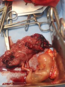 إزالة جنين «حمل» خارج الرحم بمستشفى بيلا بكفر الشيخ(صور) 1