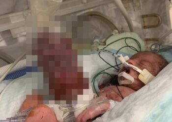 طفلة تنجو من الموت بأعجوبة بعد ولادتها بأمعاء خارج جسدها والأطباء: «عاشت بمعجزة» 1