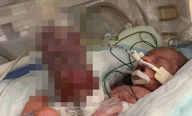 طفلة تنجو من الموت بأعجوبة بعد ولادتها بأمعاء خارج جسدها والأطباء: «عاشت بمعجزة» 1