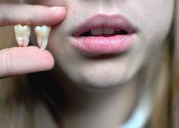 كيف تعيد الأسنان إلى مكانها بعد فقدانها.. اليك التفاصيل