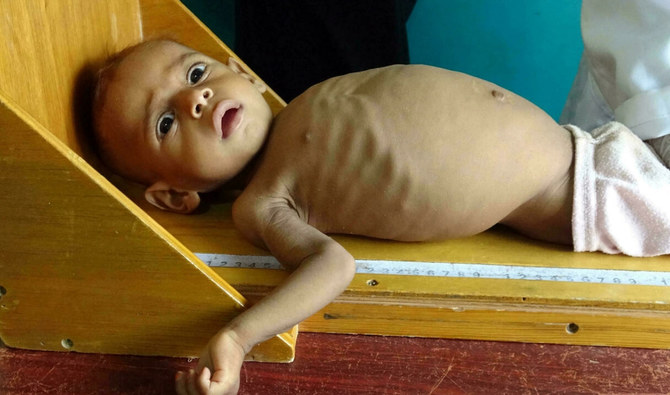 الإحصاء الفلسطيني:ارتفاع حالات الوفاة بسبب سوء التغذية في قطاع غزة 3