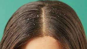 «أبرزها اللبن الرايب».. وصفات طبيعية لعلاج قشرة الشعر 10