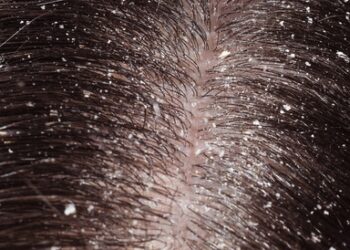 وصفات طبيعية لعلاج قشرة الشعر.. تعرفي عليها الآن 7