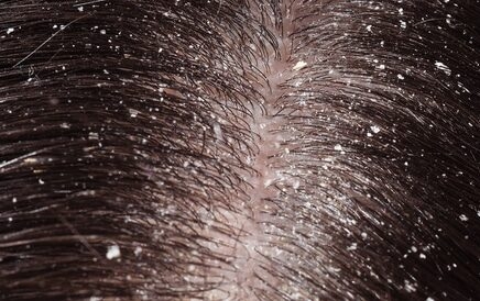 وصفات طبيعية لعلاج قشرة الشعر.. تعرفي عليها الآن 1