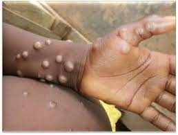 «الصحة العالمية»: لا ضرورة للتطعيم الجماعي ضد فيروس "جدري القرود" 4