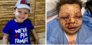 "يامن" ابن الـ 5 سنوات.. مأساة طفل أصابه "خرطوش" فرح بانفجار في العين| صورة 1