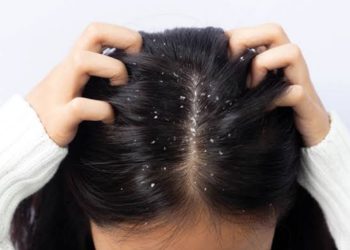 اسباب وجود قشرة الشعر .. منها التوتر واستخدام العطور 1