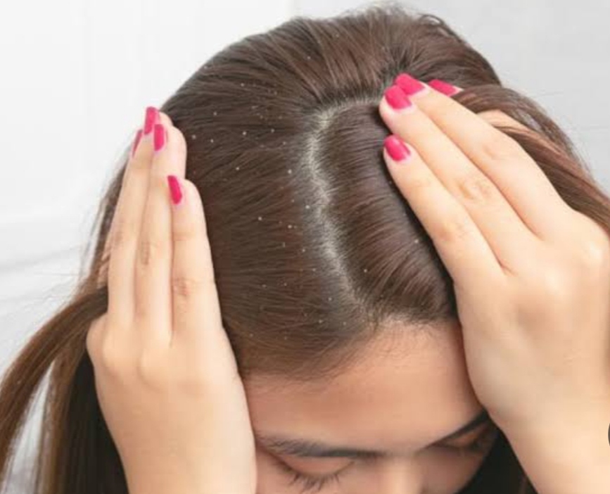 اسباب وجود قشرة الشعر .. منها التوتر واستخدام العطور 3