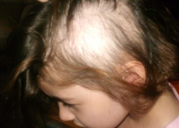 اسباب نفسية وسلوكية وراء تساقط شعر الأطفال 1