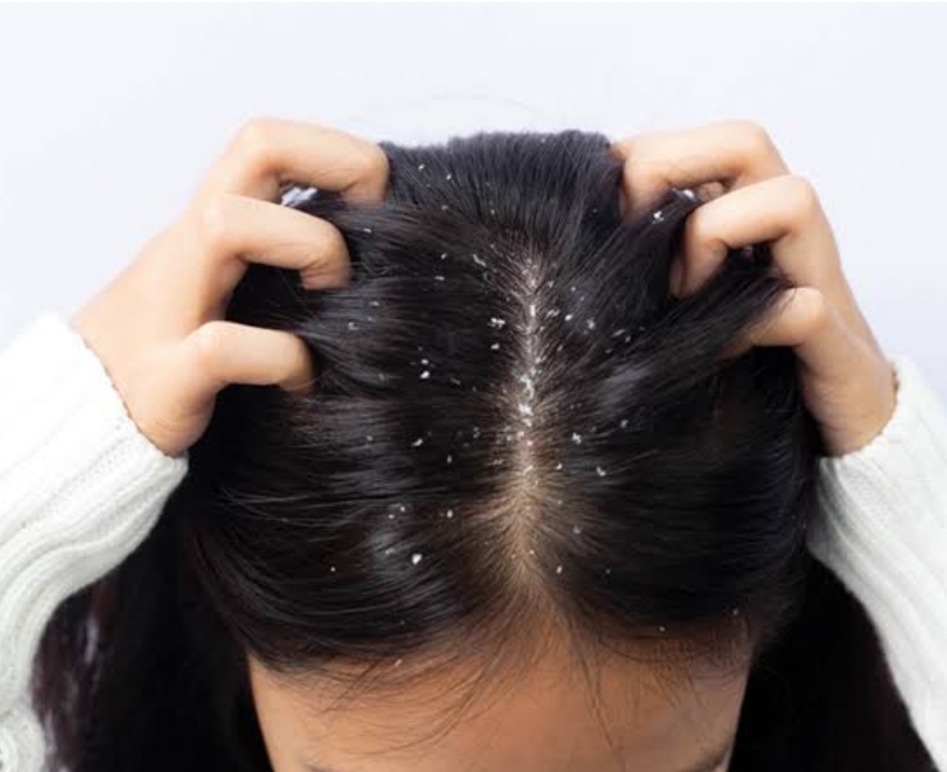 لعلاج الهرش والحكة.. وصفات طبيعية تخلصك من قشرة الشعر 2