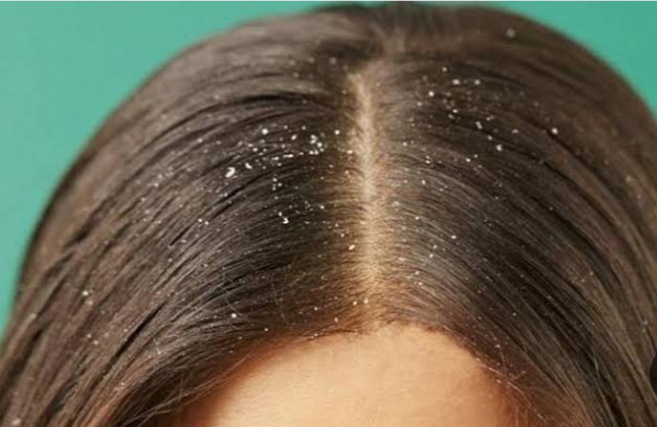 لعلاج الهرش والحكة.. وصفات طبيعية تخلصك من قشرة الشعر 3