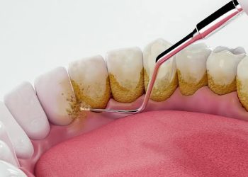 لعدم تراكم البلاك.. 5 خطوات لتنظيف الأسنان في شهر رمضان 6