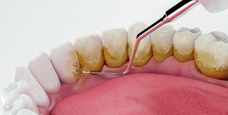 لعدم تراكم البلاك.. 5 خطوات لتنظيف الأسنان في شهر رمضان 1
