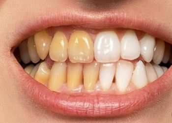 بدون ليزر.. وصفات طبيعية لتبييض الأسنان والتخلص من الإصفرار 11