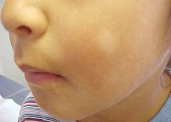 استشاري يكشف أسباب البقع البيضاء على بشرة الأطفال.. والفرق بين مرض النخالة والبهاق 1