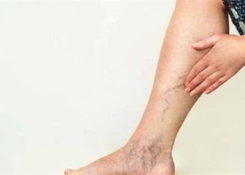 6 علامات تظهر على ساقيك وتنذر بوجود مرض خطير بالقلب.. اكتشفها الآن 3